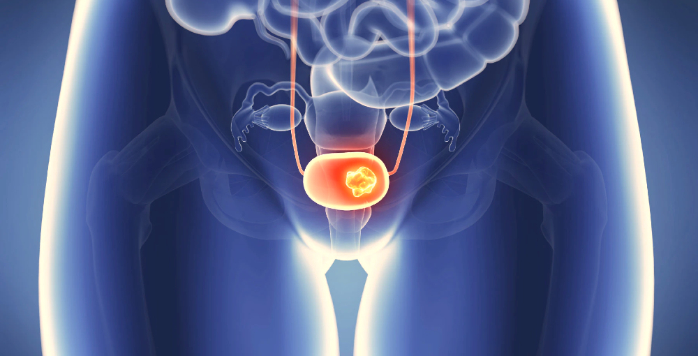 bladder cancer.jpg